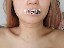 体验后-More摩尔医美の注射线雕光电中心