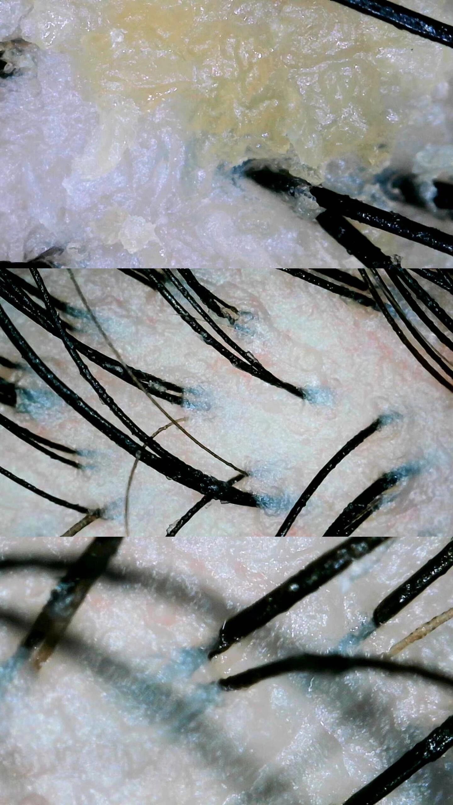 Comprehensive Analysis of Early-Onset Alopecia