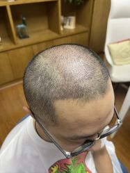 -大麦微针植发全国连锁