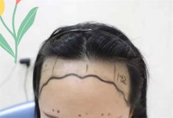 点击看大图 -大麦微针植发全国连锁