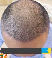 -大麦微针植发丨全国连锁