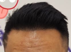 -大麦微针植发全国连锁