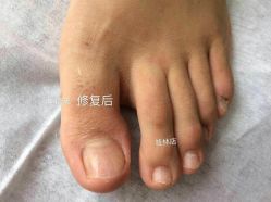 -德哥灰指甲脚气甲沟炎跖疣护理