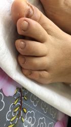 -德哥灰指甲脚气甲沟炎跖疣护理