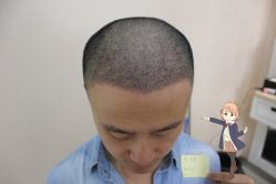 -大麦微针植发丨全国连锁