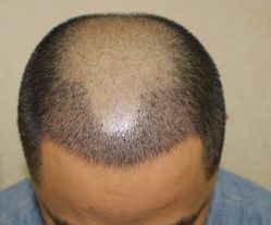 -大麦微针植发全国连锁