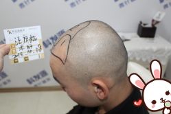 点击看大图 -大麦微针植发丨全国连锁