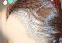 -大麦微针植发全国连锁