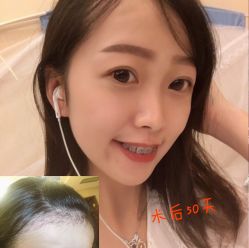 -大麦微针植发丨全国连锁