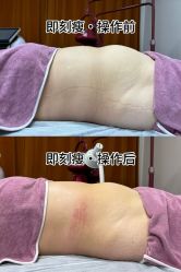 -苗塑堂减肥·艾灸