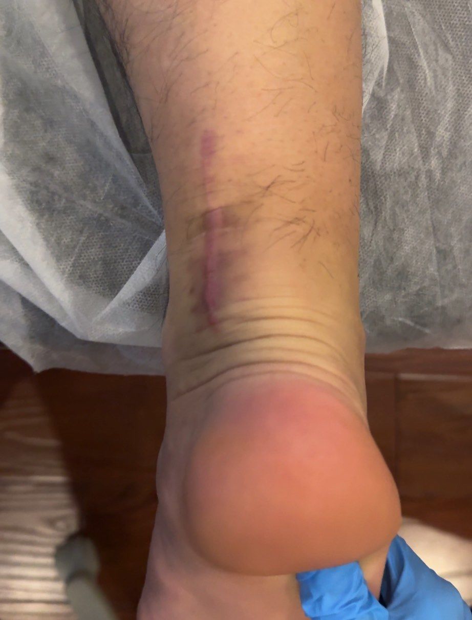 跟腱术后瘢痕松解改善活动受限