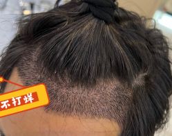 -大麦微针植发全国连锁