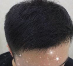 -大麦微针植发全国连锁