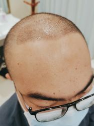 点击看大图 -碧莲盛·不剃发植发