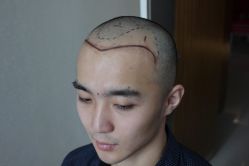 点击看大图 -大麦微针植发丨全国连锁