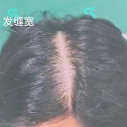 -北京雍禾植发医院