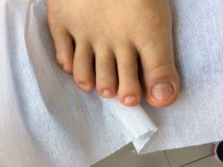 -德哥灰指甲脚气甲沟炎跖疣护理