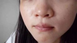 体验后-丽美妍医疗美容·皮秒·立体分层抗衰