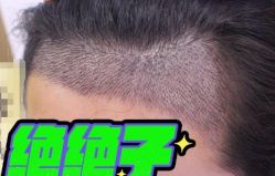 -大麦微针植发丨全国连锁