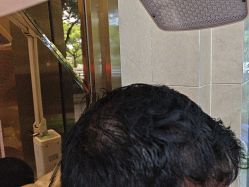 -碧莲盛·不剃发植发