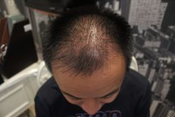 点击看大图 -大麦微针植发丨全国连锁