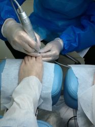 -派恩宜灰指甲鸡眼嵌甲手足癣