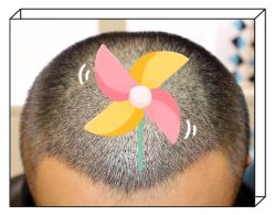 -大麦微针植发全国连锁