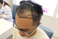 -大麦微针植发丨全国连锁