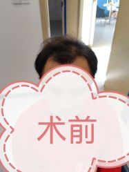 -大麦微针植发全国连锁