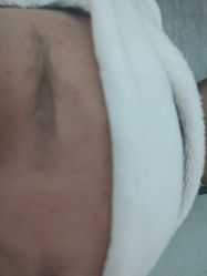 体验前-痘庄科学祛痘国际连锁