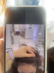 -大麦微针植发丨全国连锁