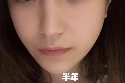 体验后-西安壹加壹医疗美容·西北抗衰旗舰店