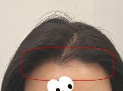 -大麦微针植发全国连锁