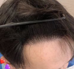 -大麦微针植发丨全国连锁