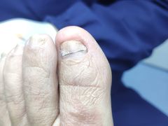 -Andrew指甲专科灰指甲·甲沟炎矫正·3D步态矫形鞋垫定制(上海法华镇路旗舰店)