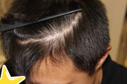 -大麦微针植发丨全国连锁