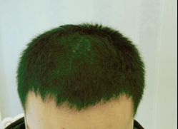 -大麦微针植发丨全国连锁