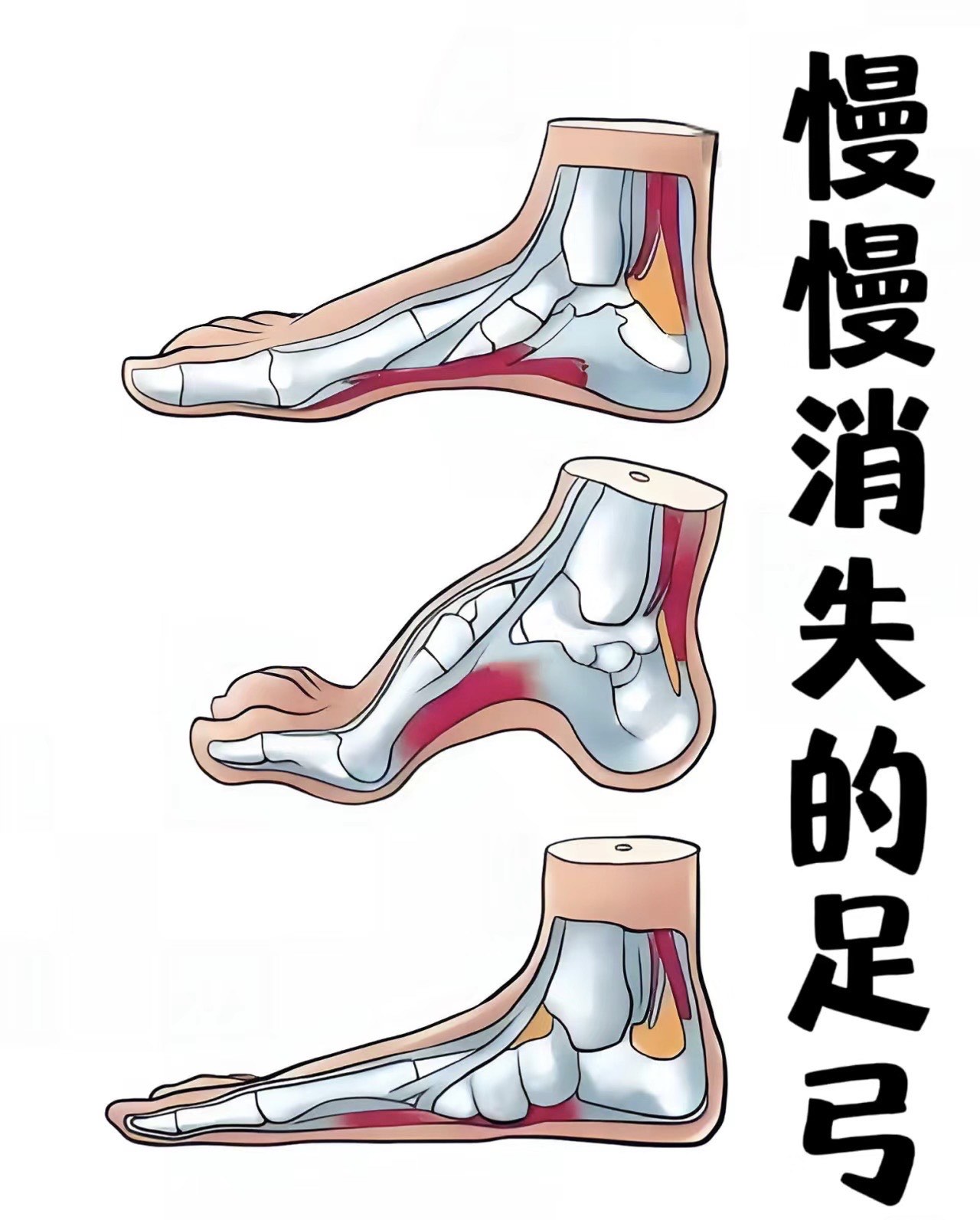 足弓肿了一个包图片图片