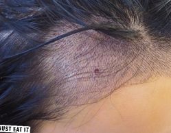 -大麦微针植发丨全国连锁