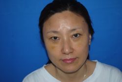 -天津健丽·去眼袋医疗美容机构