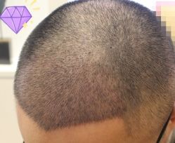 -大麦微针植发丨全国连锁