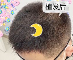 -大麦微针植发全国连锁