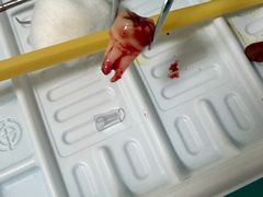 -上海仁爱医院口腔科 · 种植
