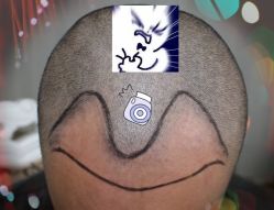 -大麦微针植发全国连锁