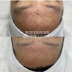 -美肤盾祛痘·问题肌头疗管理中心