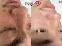 -苗方清颜专业祛痘连锁机构