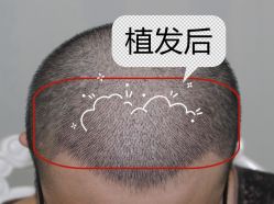 -大麦微针植发全国连锁