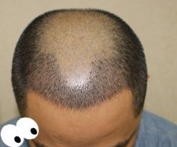 -大麦微针植发丨全国连锁