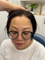 体验后-大麦微针植发全国连锁