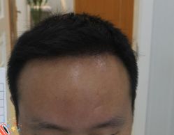 -大麦微针植发丨全国连锁